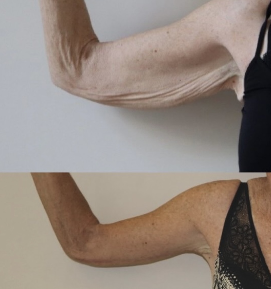 Avant/Après lifting des bras